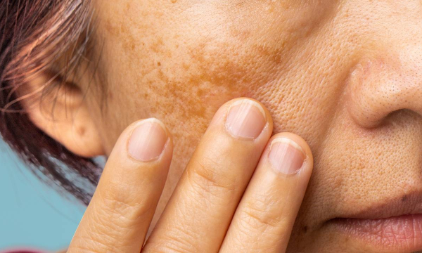 Врач назвала способы профилактики пигментных пятен